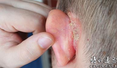 你的耳朵后面隐藏着什么？危险信号你知道吗？
